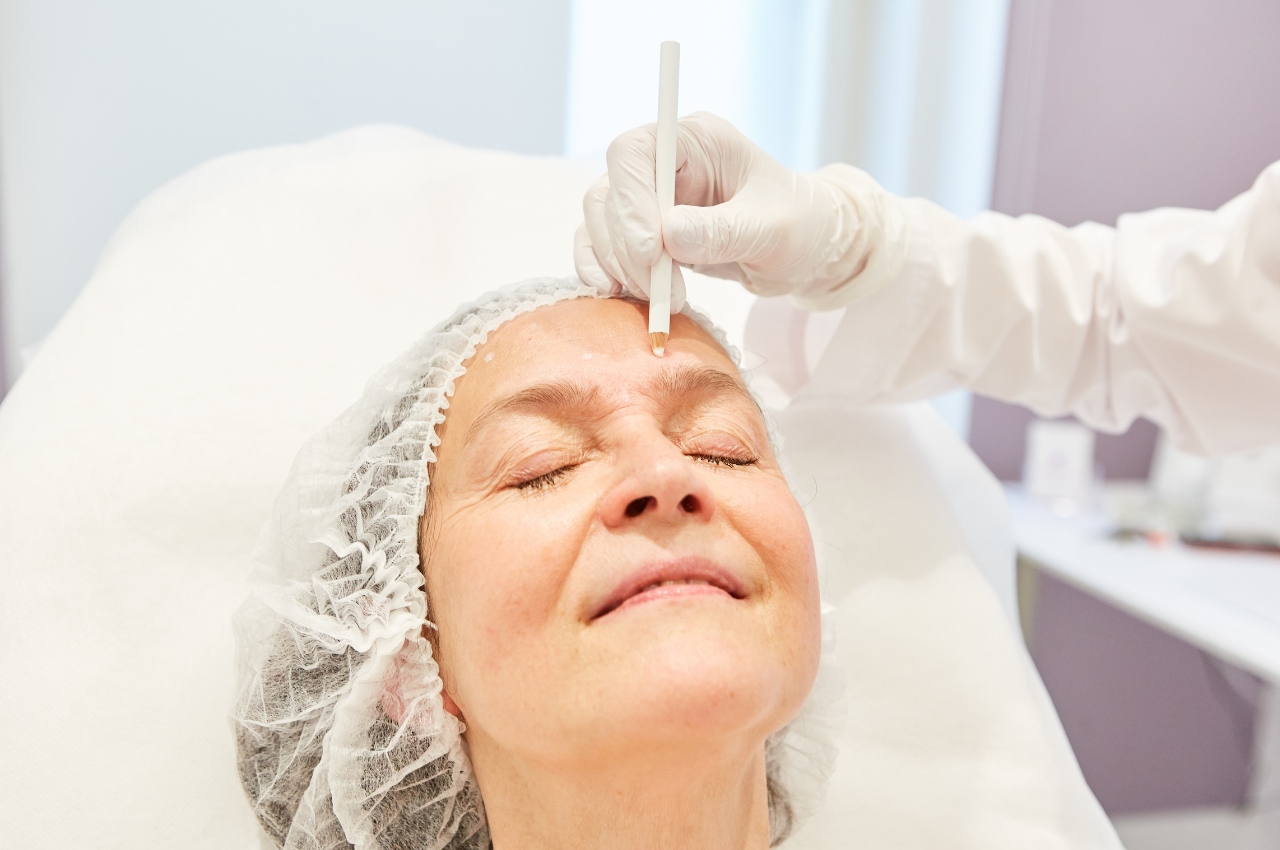 Facelift bei einer Frau vom Facharzt durchgeführt