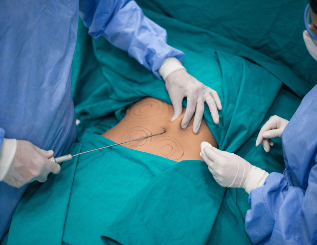 Fettabsaugung einer Patientin in der Belaris Clinic